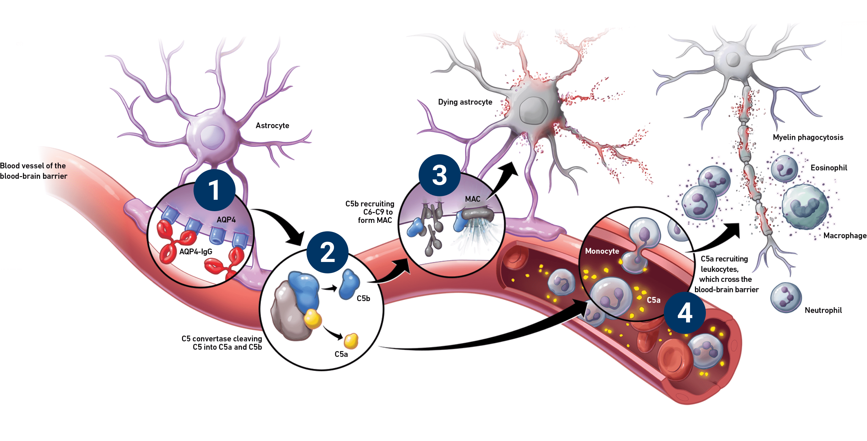Diagram detailing the four steps through which complement activation can cause damage