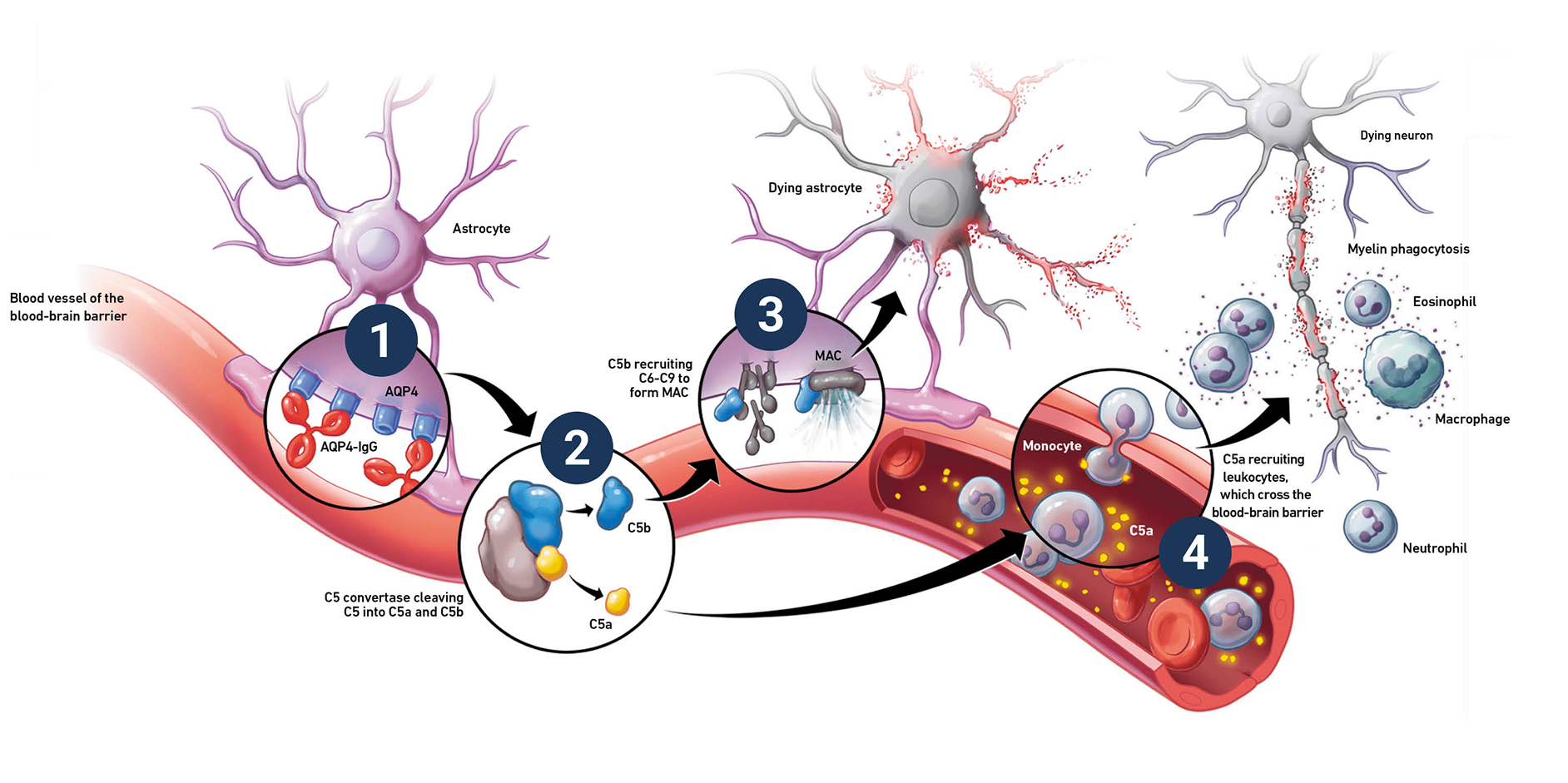 Diagram detailing the four steps through which complement activation can cause damage